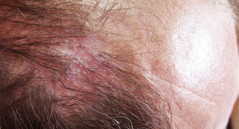 Diskoid Lupus Eritematosus